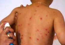 Les cas de rougeole dans le monde ont triplé depuis le début de l’année