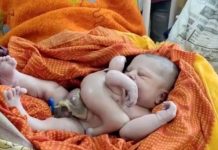 Inde: Un bébé naît avec un troisième bras